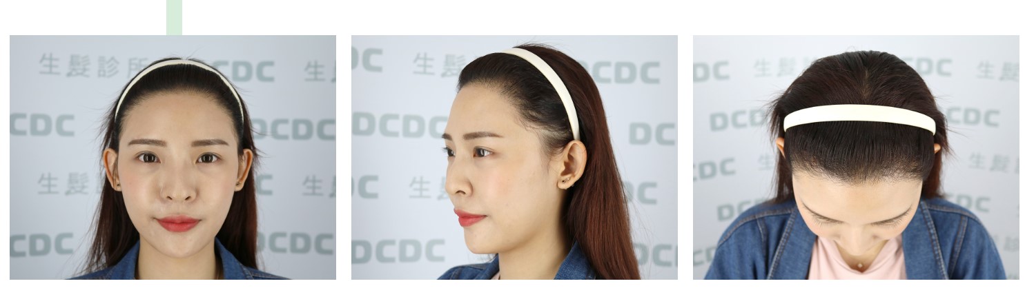 DCDC髮際線植髮手術後，看起來年輕自信許多